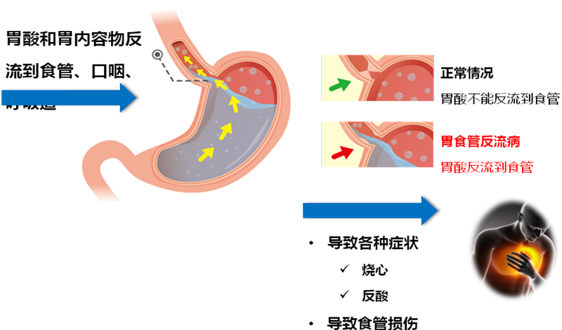 經常反酸水，來認識一下胃食管反流